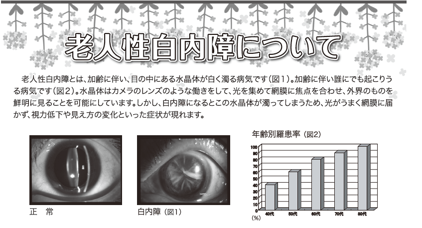 PL病院ニュース2025年4月号（老人性白内障）